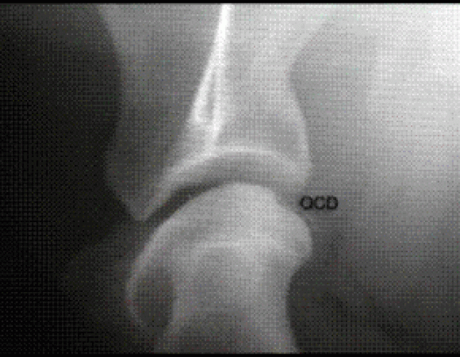 OCD Lesions